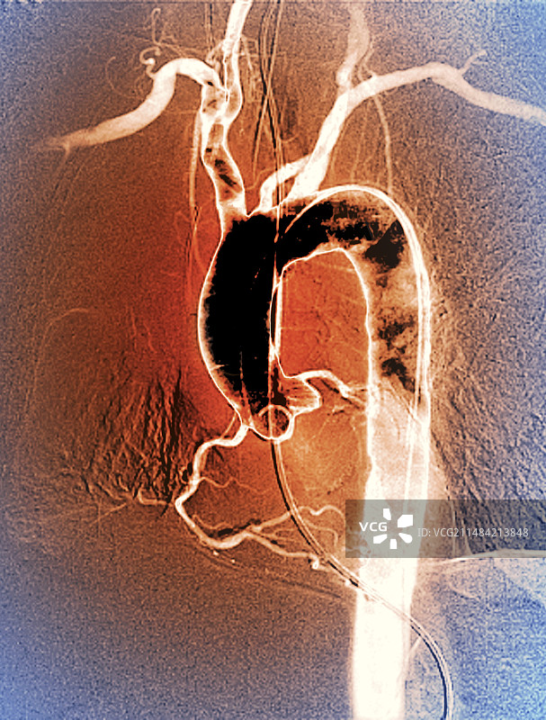 主动脉弓X光片图片素材