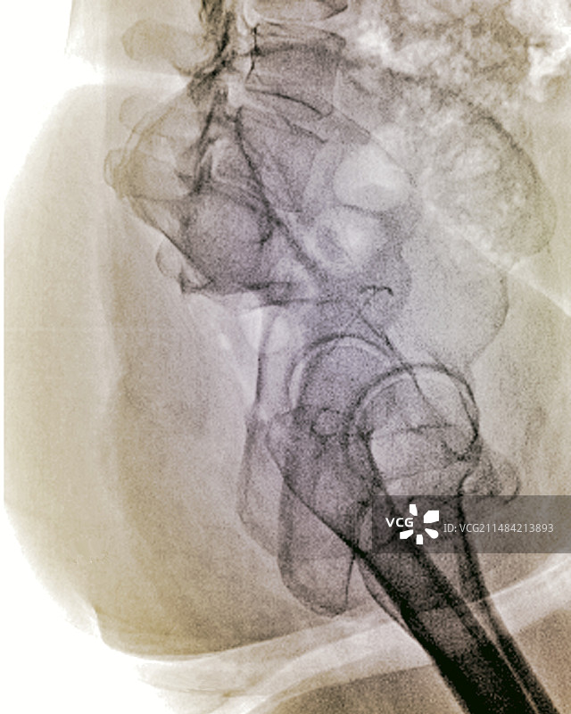 未发育的骨盆X光片图片素材