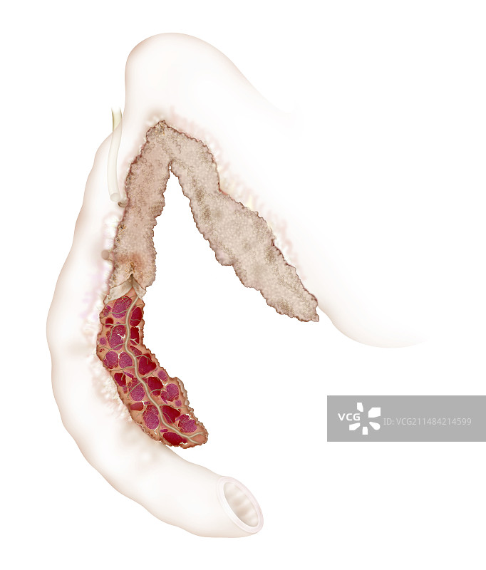 患病的犬胰腺插图图片素材