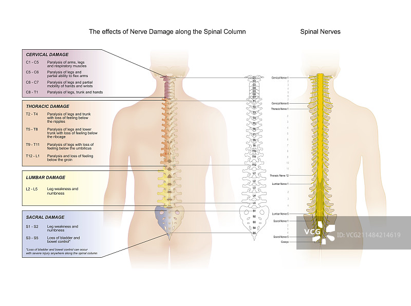脊神经损伤插图图片素材
