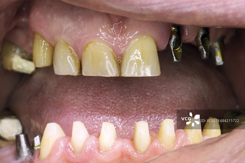 牙科种植体图片素材