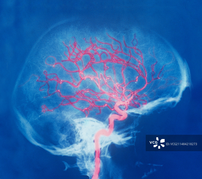 头部血管X光图片素材