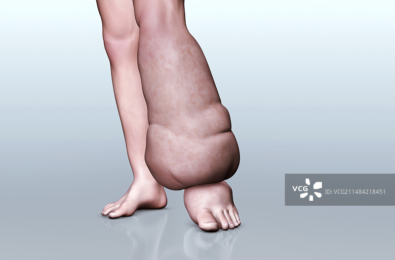 象皮病插图图片素材