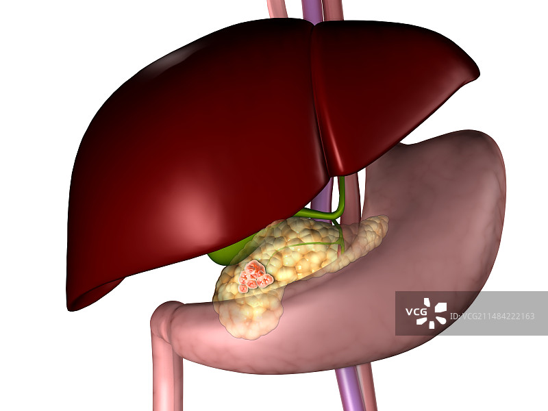 胰腺癌示意图图片素材