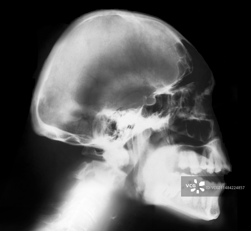 小头畸形，X光片图片素材