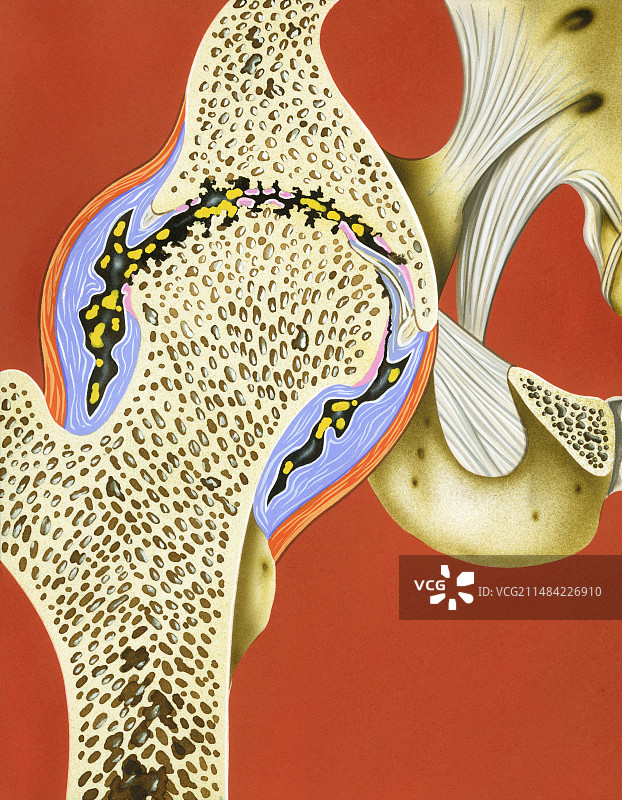 髋关节软骨损失图示图片素材