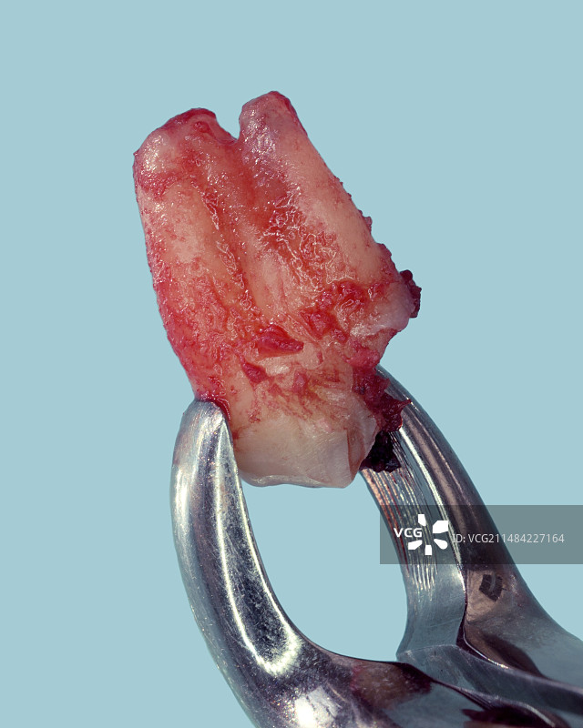 拔出的智齿图片素材