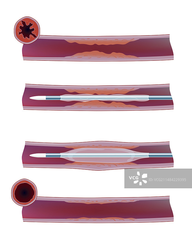 静脉血栓中的球囊扩张图片素材