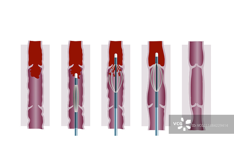 静脉修复，插图图片素材
