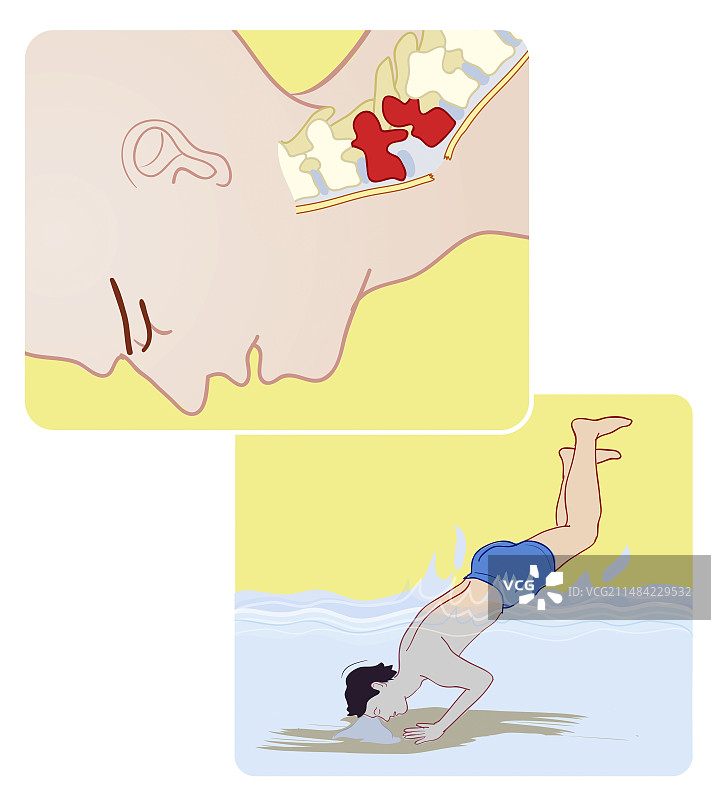 潜水损伤引起的脊柱骨折图片素材
