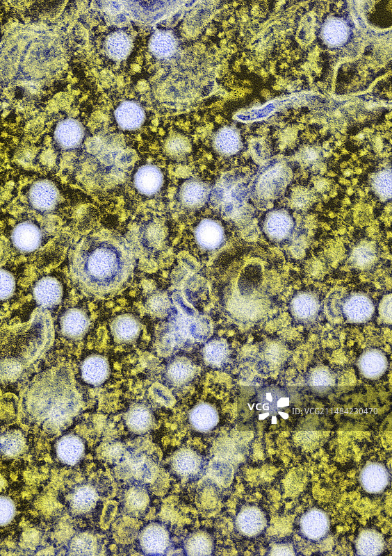 单纯疱疹病毒感染，TEM图片素材
