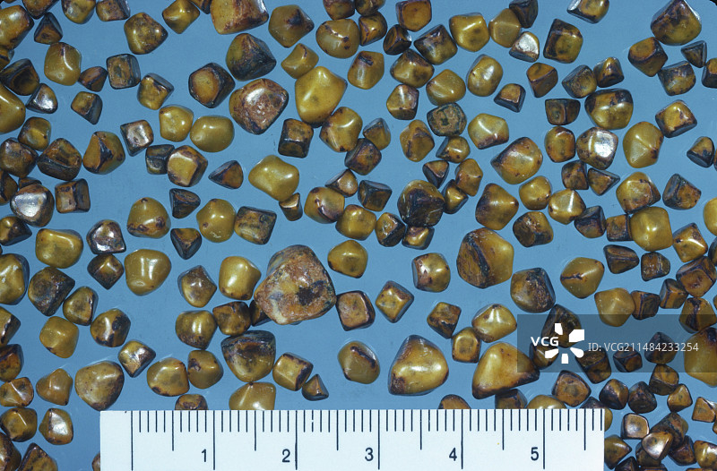 胆结石图片素材