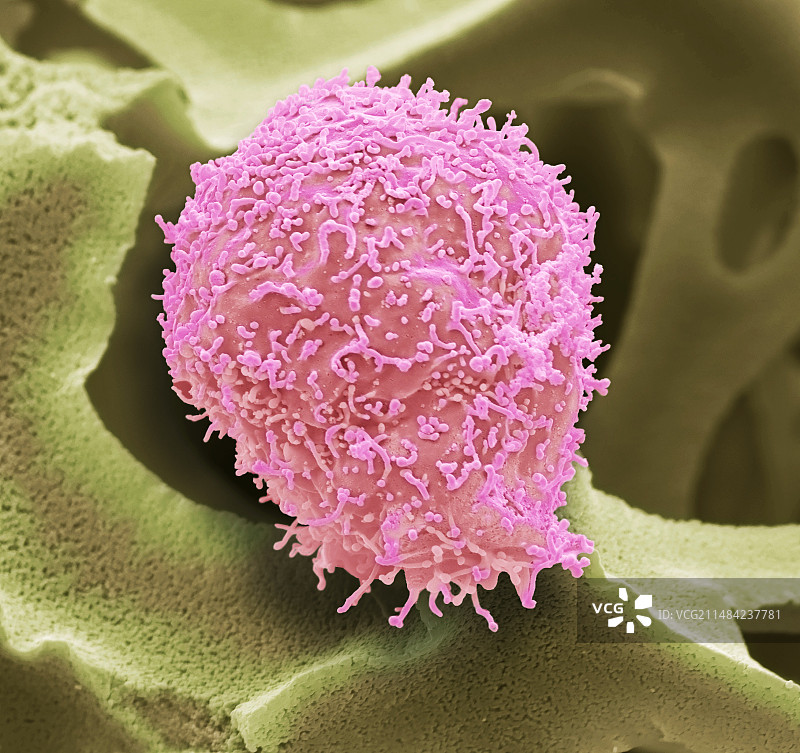 宫颈癌细胞扫描电镜图图片素材