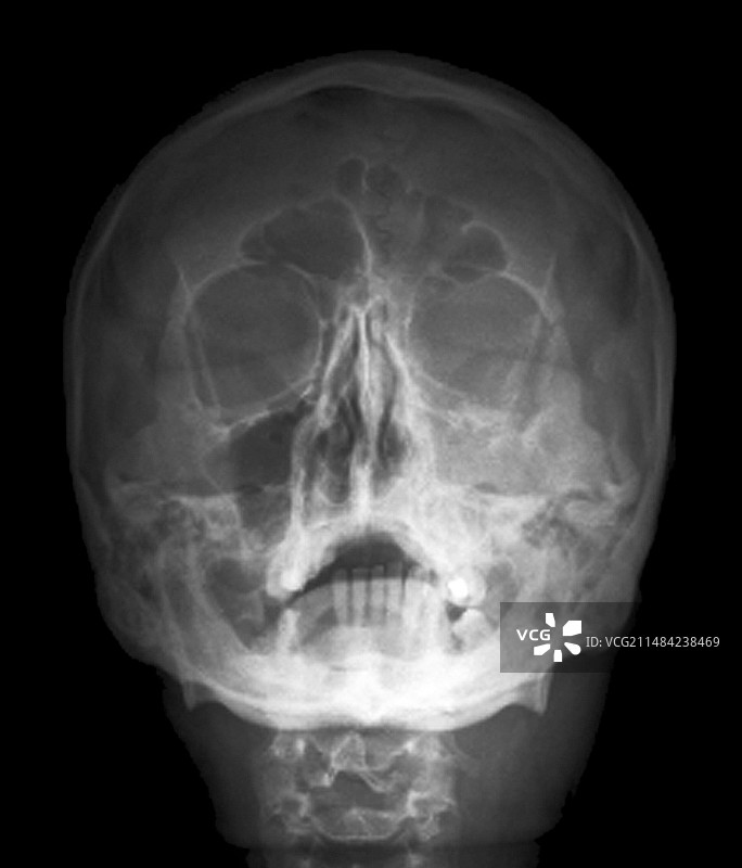 颅骨骨折X光片图片素材