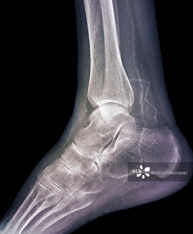 踝动脉钙化X光片图片素材