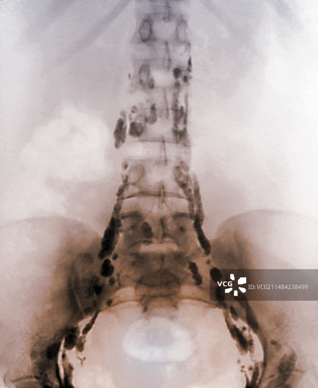 正常淋巴系统X光片图片素材