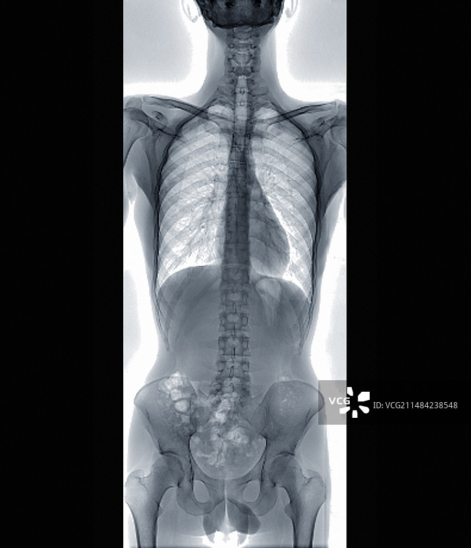 正常脊椎X光片图片素材