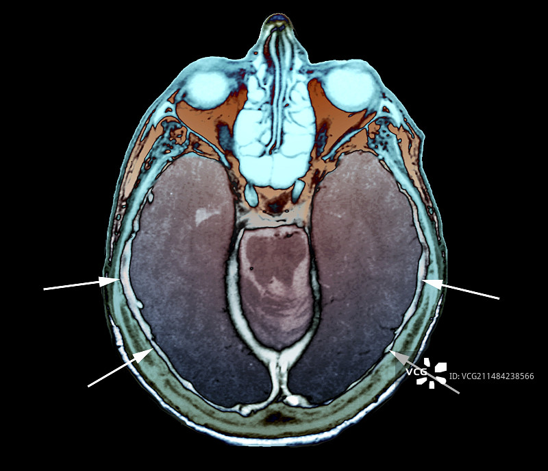 Pachymeningitis, MRI图片素材