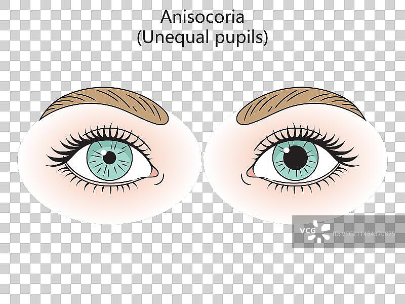 人类不等视示意图医学图片素材