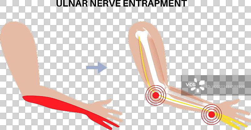 尺神经卡压图片素材