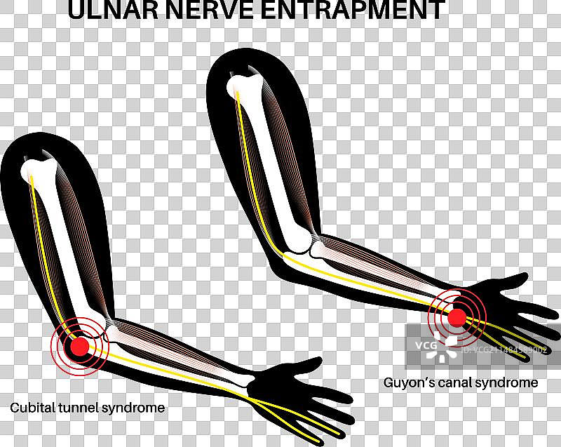 尺神经卡压图片素材