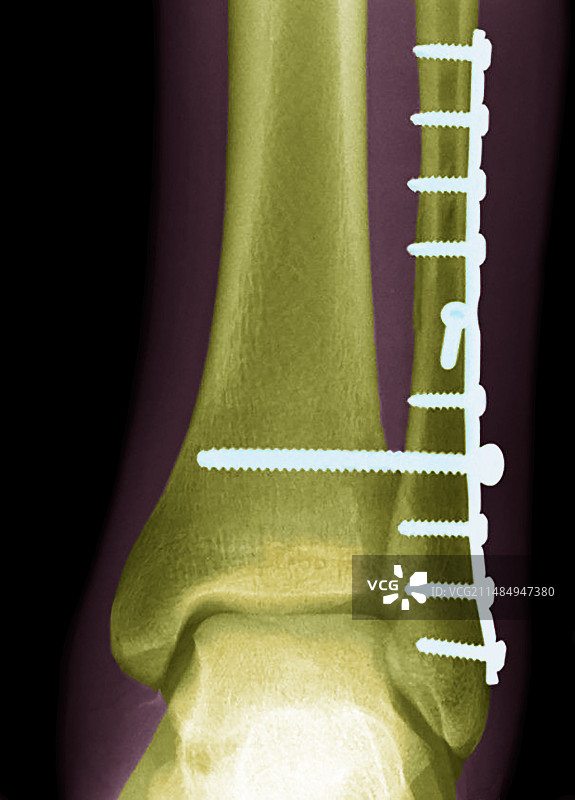 踝关节骨折X光片图片素材