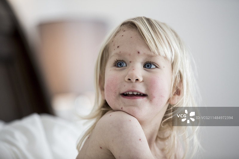 患有水痘的女孩图片素材