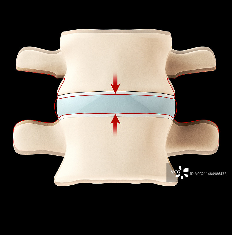 椎间盘压力图片素材
