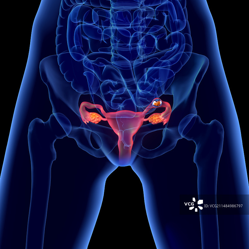异位妊娠图片素材