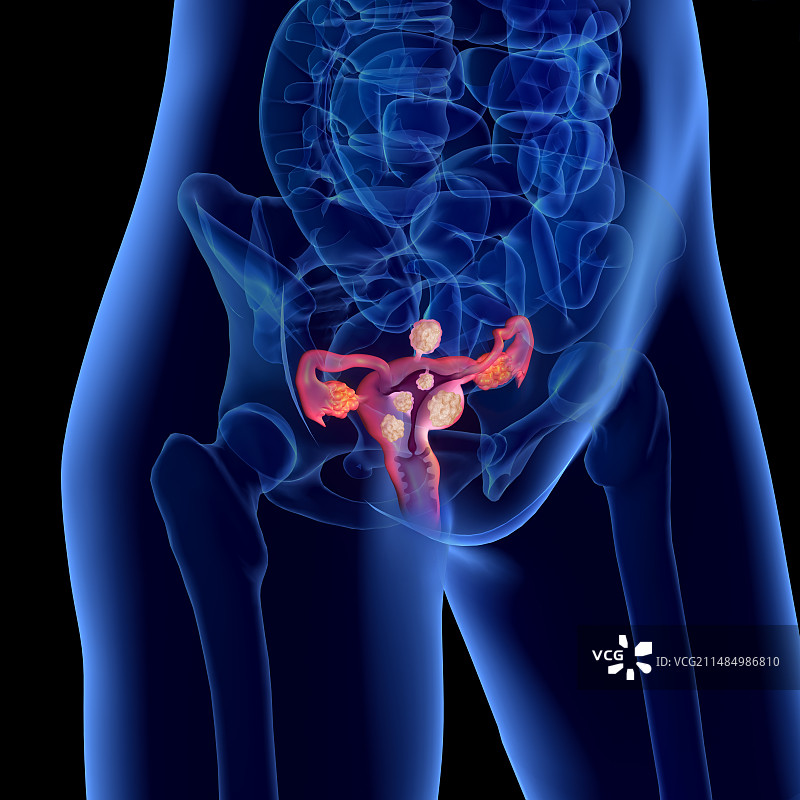 子宫肌瘤，绘画图片素材