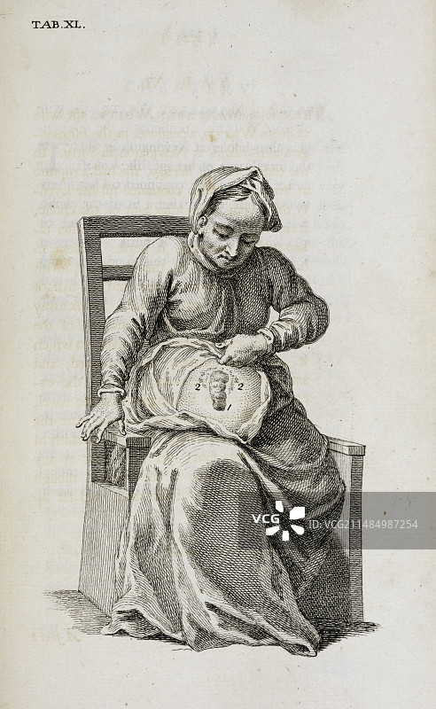 18世纪的结肠造口术图片素材