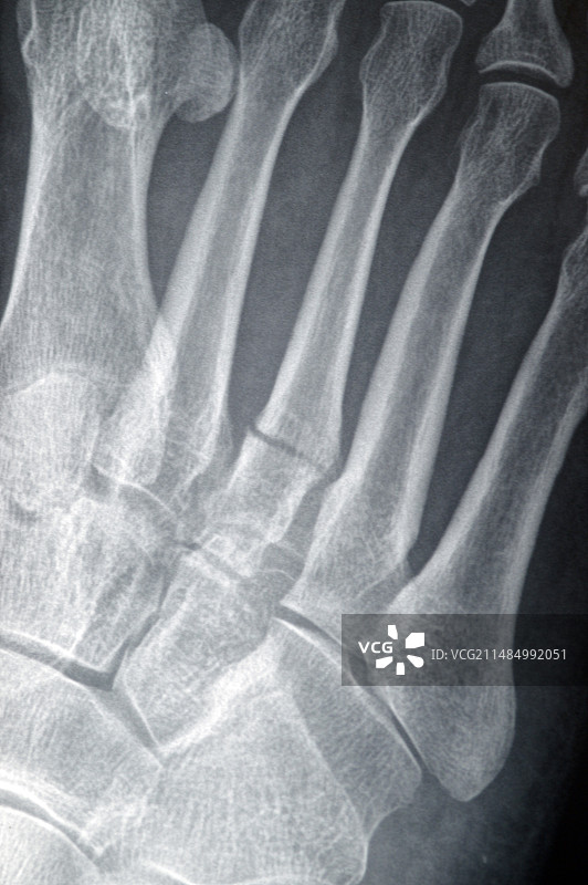 骨折的脚趾，X光片图片素材