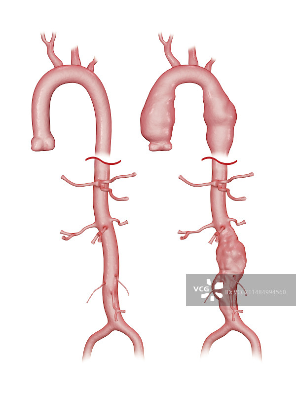 主动脉动脉瘤插图图片素材