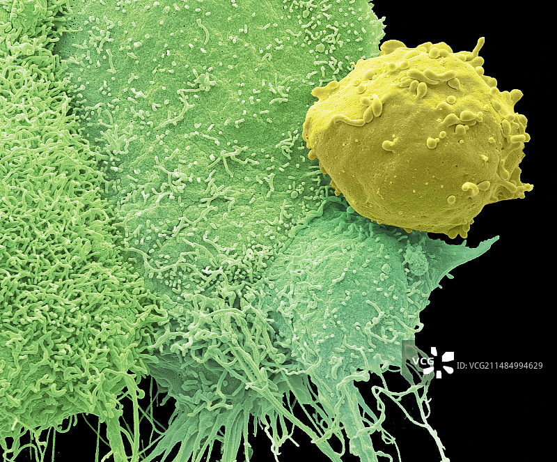 癌细胞和单核细胞扫描电镜图图片素材