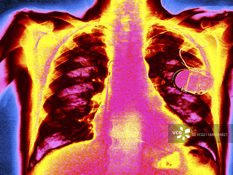 除颤器，彩色胸部X光片图片素材