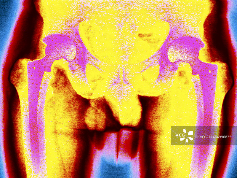 彩色X光双侧髋关节置换图片素材