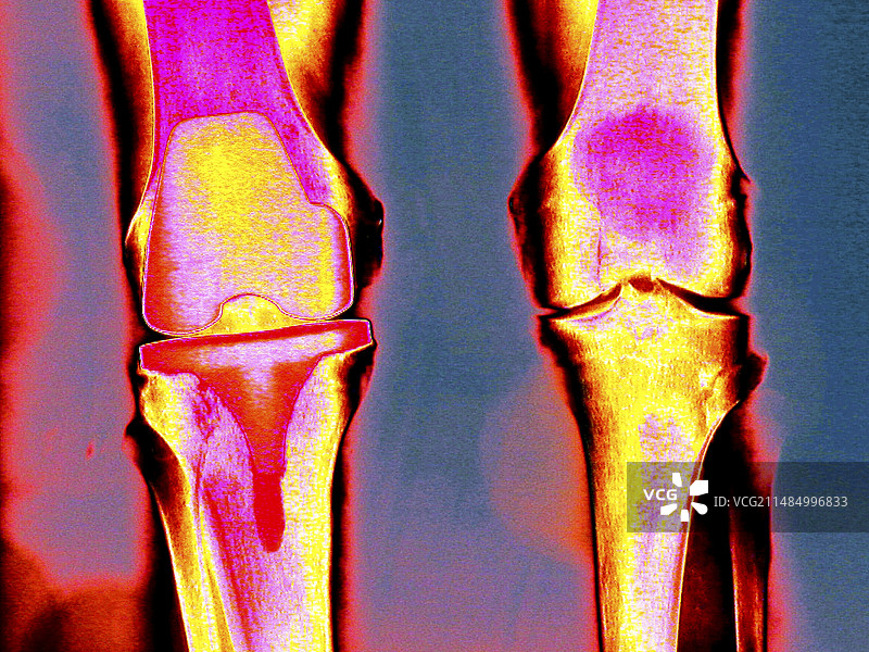 膝关节置换彩色X光片图片素材