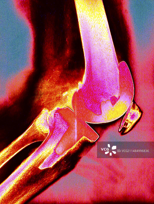 膝关节置换彩色X光片图片素材