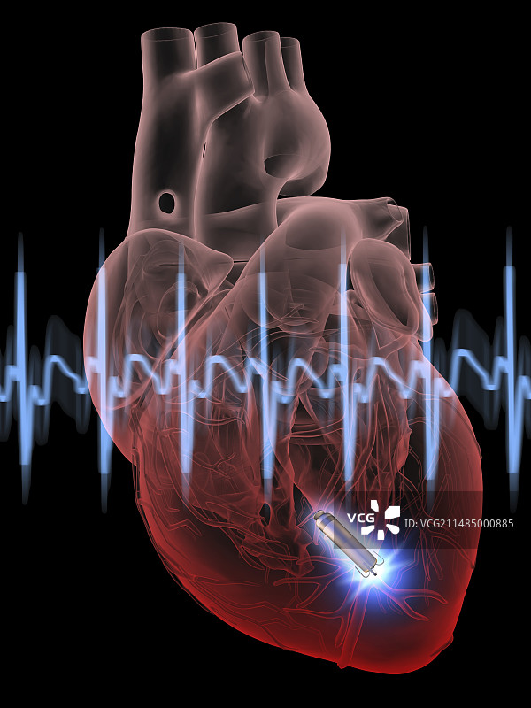 带有无导线心脏起搏器的心形图片素材