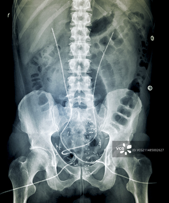 膀胱癌术后X光片图片素材