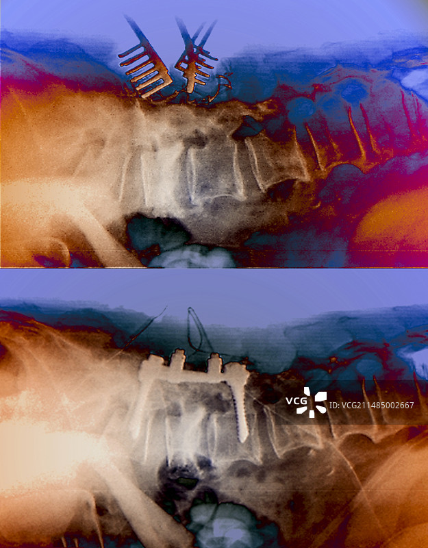 外科手术中的脊椎压缩性骨折图片素材