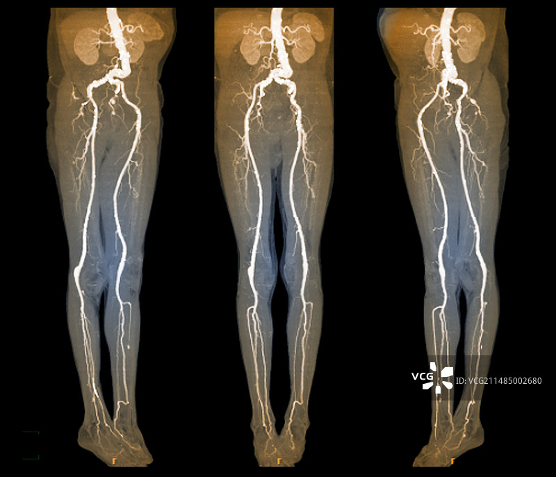 动脉瘤，X光片图片素材