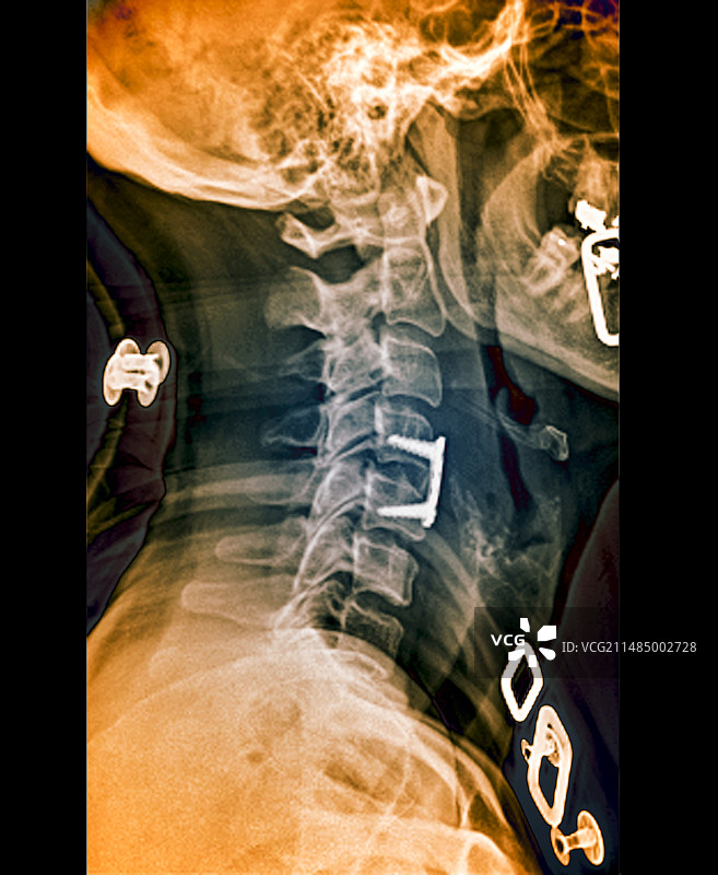 治疗后的椎间盘突出图片素材