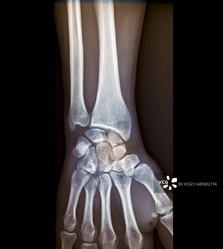 手腕骨折X光片图片素材