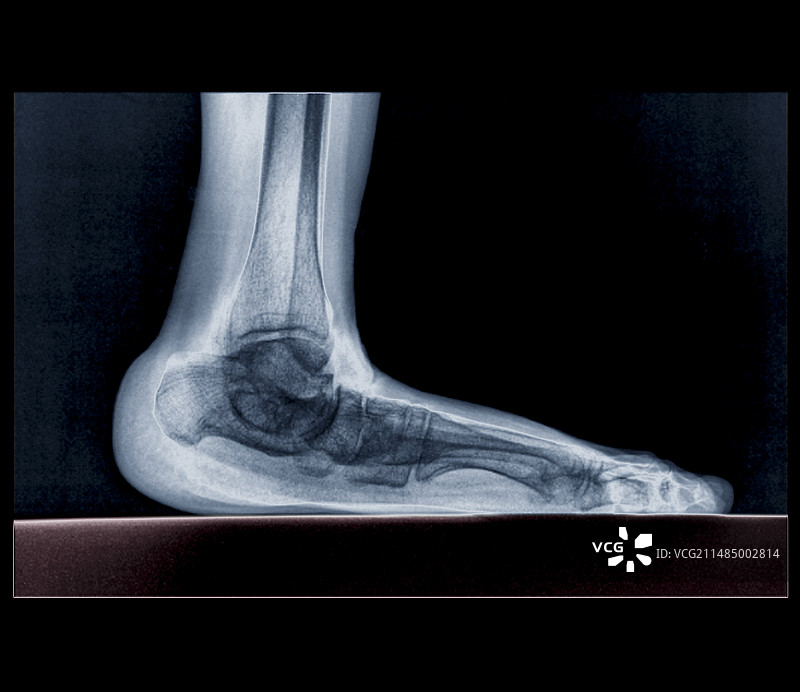 扁平足X光片图片素材