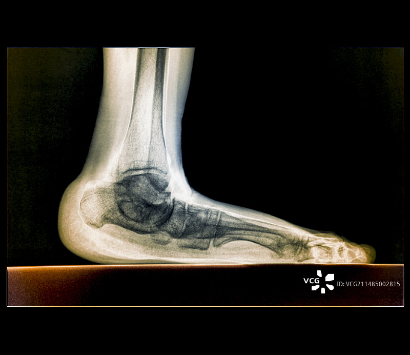 扁平足X光片图片素材