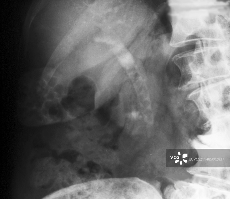 胆结石X光片图片素材