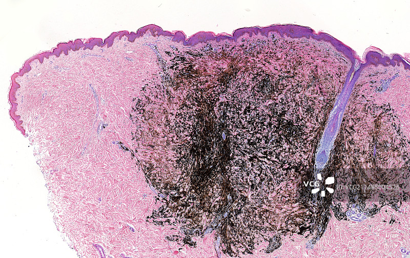 皮肤痣浅显显微照片图片素材
