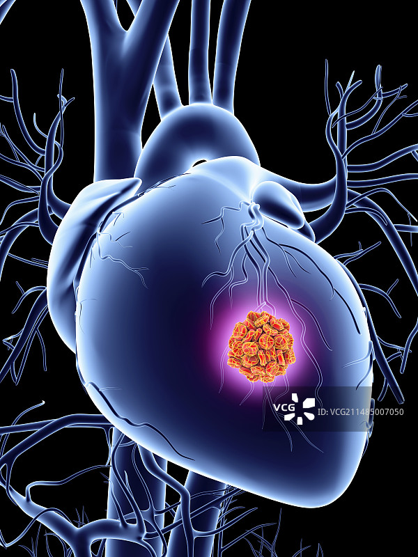 心脏病发作概念艺术作品图片素材