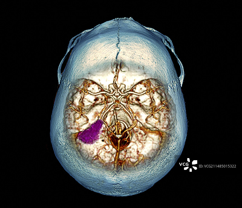 脑肿瘤3D CT扫描图片素材